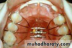 posterior crossbite
