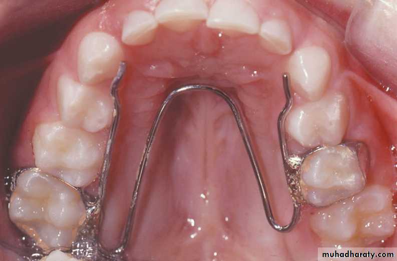 posterior crossbite