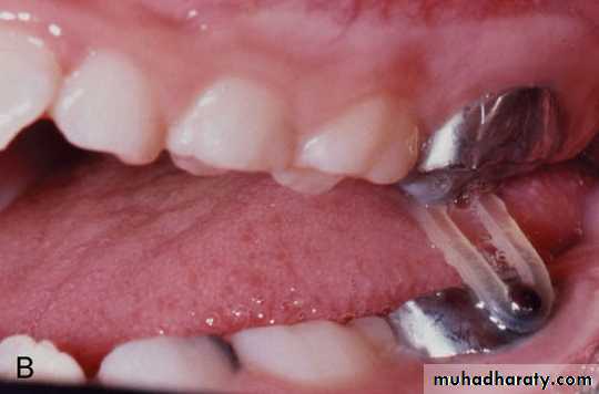 posterior crossbite