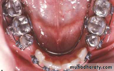 posterior crossbite