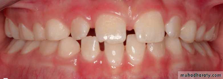 posterior crossbite