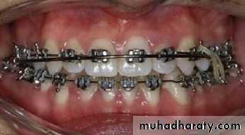 posterior crossbite
