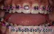 posterior crossbite