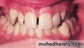 posterior crossbite