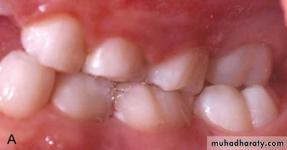 posterior crossbite