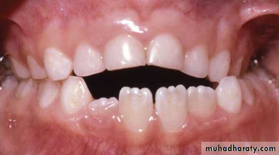 posterior crossbite