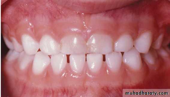 posterior crossbite