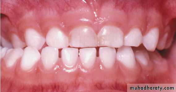 posterior crossbite