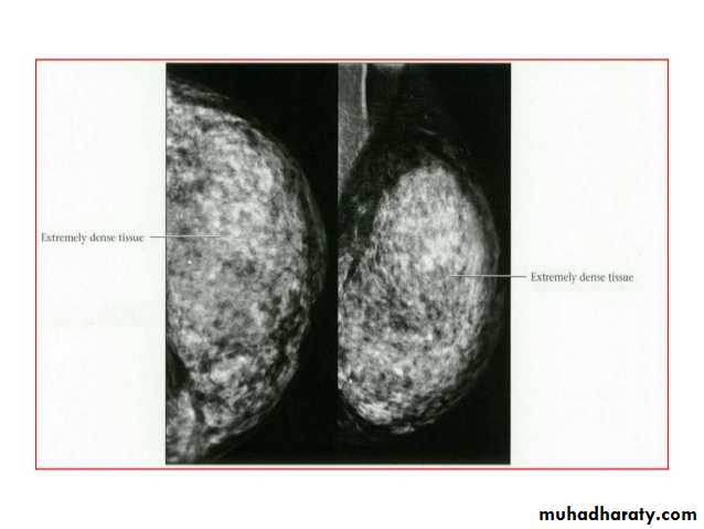Mammogram