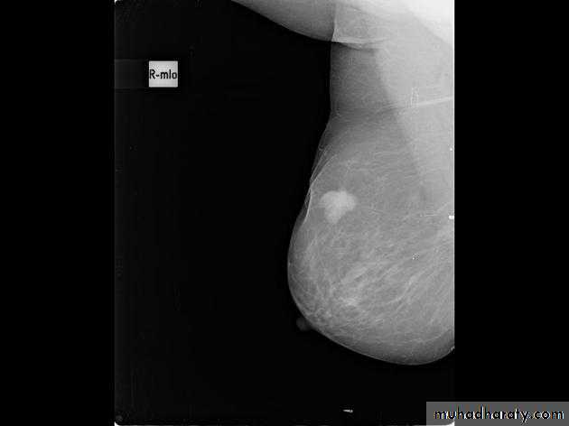 Mammogram