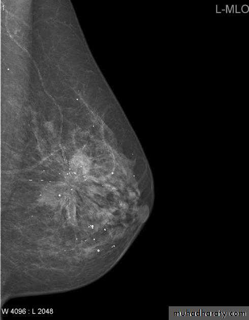 Mammogram