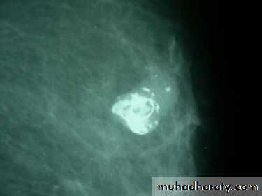 Mammogram