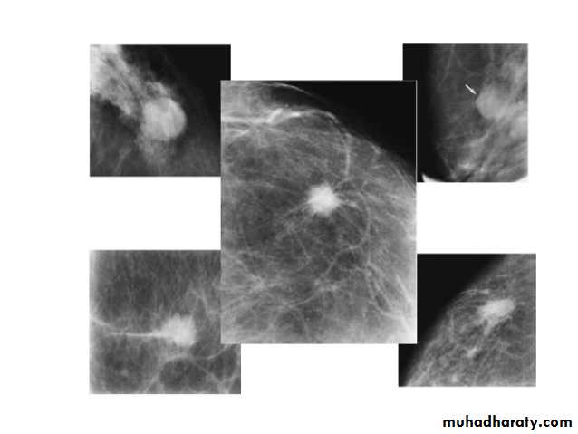 Mammogram