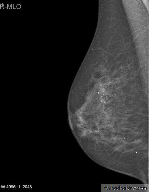 Mammogram