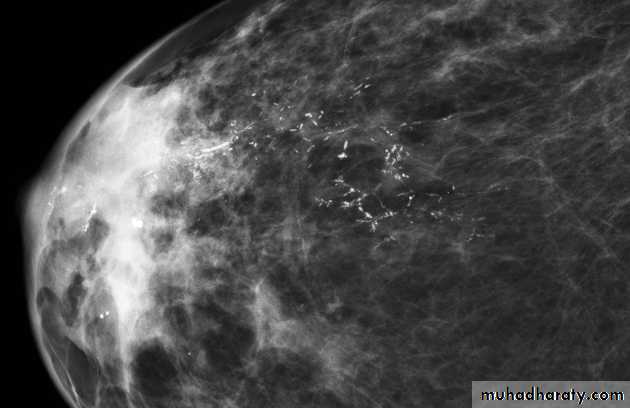 Mammogram