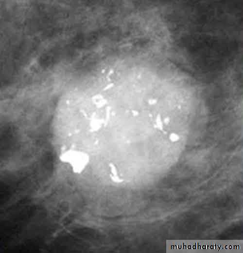 Mammogram