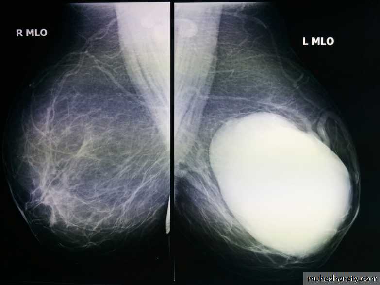 Mammogram
