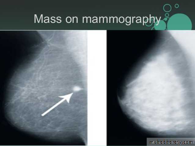 Mammogram