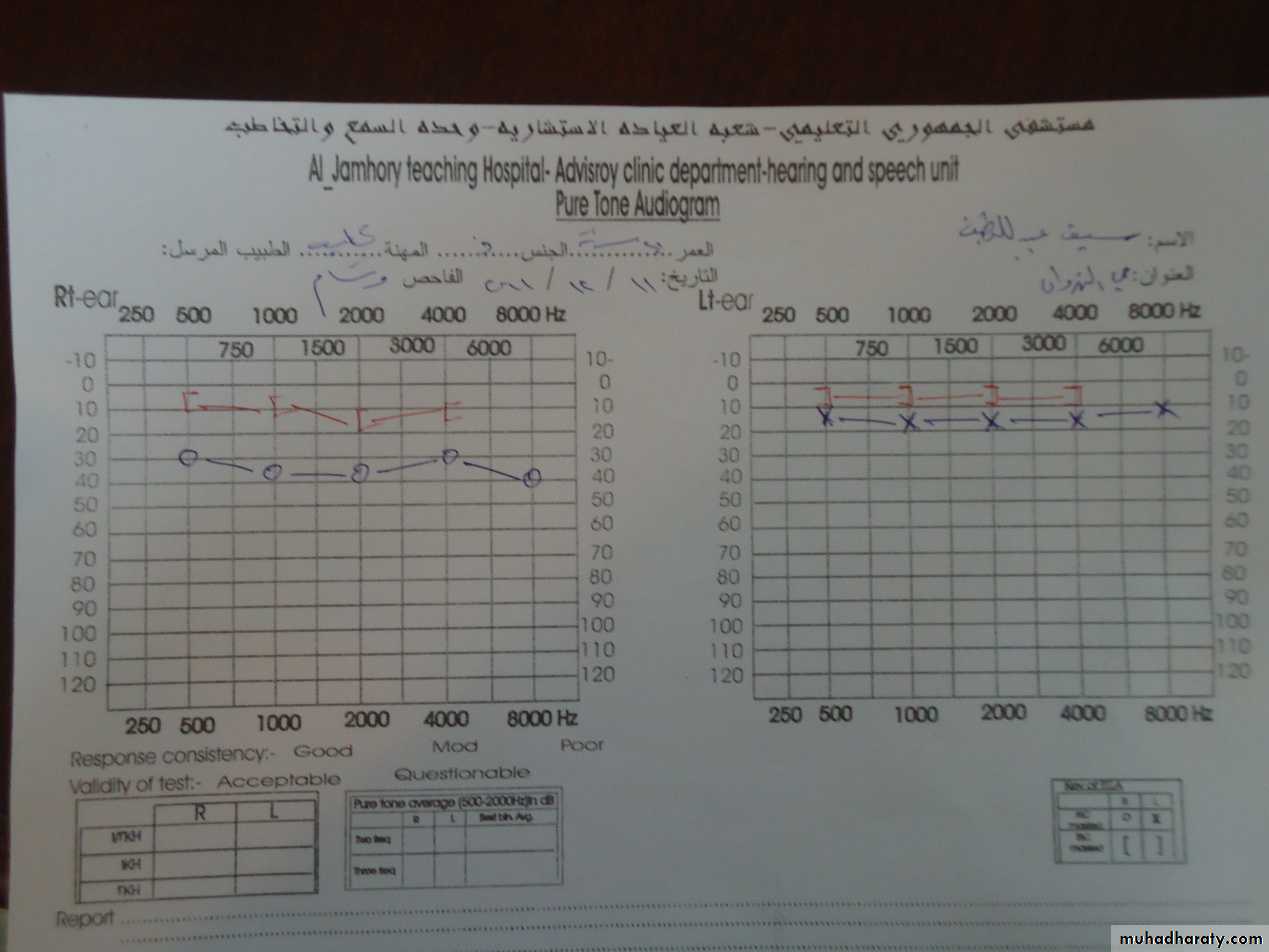 audiogram
