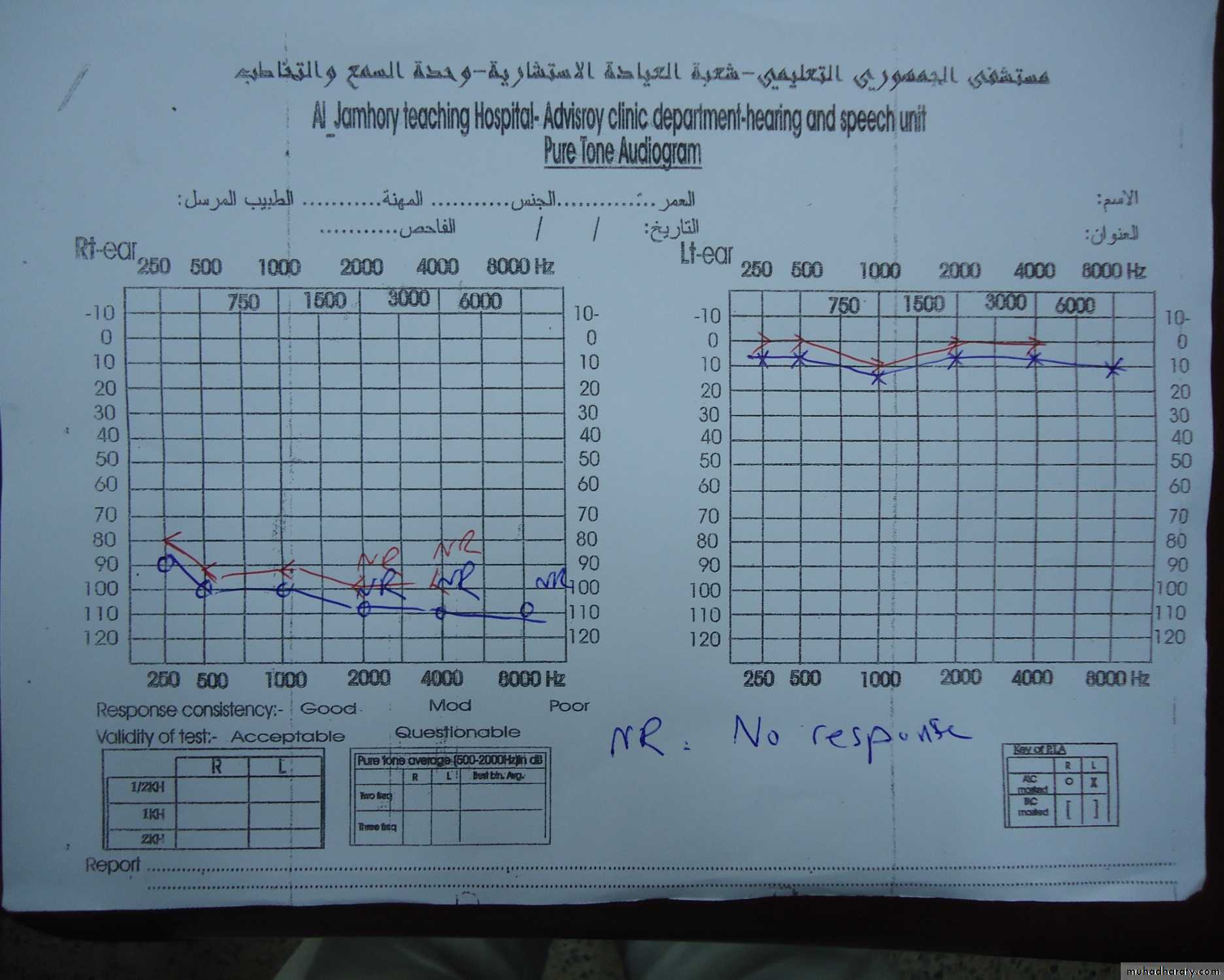audiogram