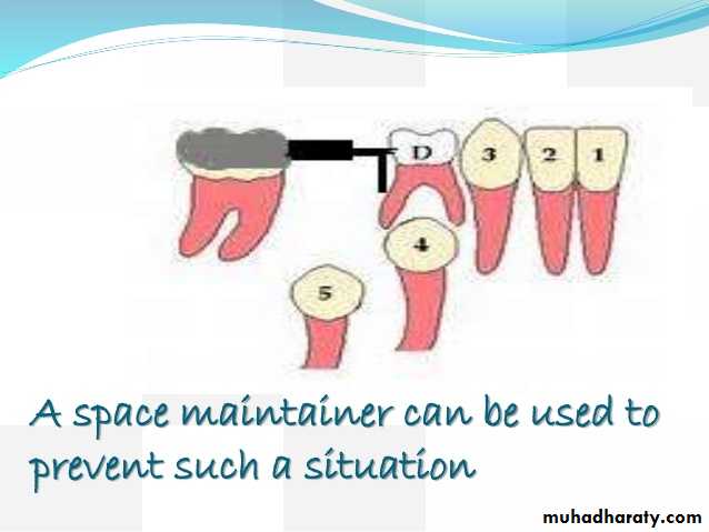 space maintainer