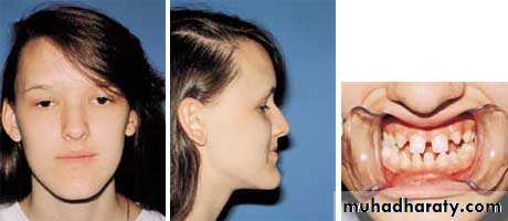 orthognathic surgery