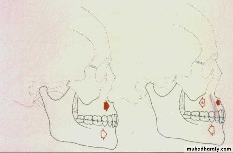 orthognathic surgery