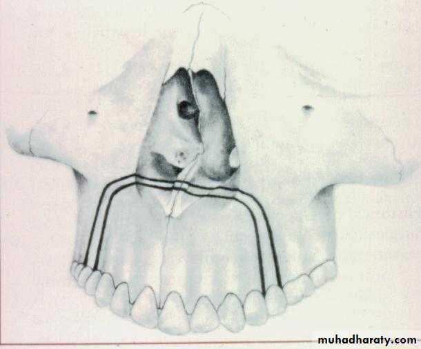 orthognathic surgery