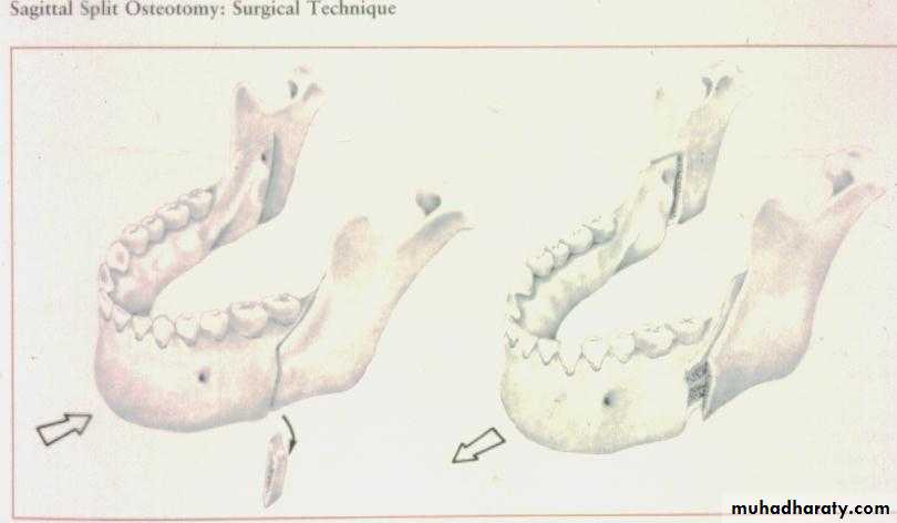 orthognathic surgery