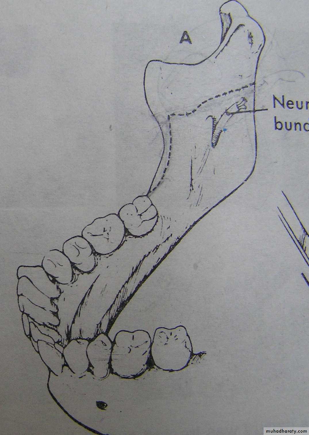 orthognathic surgery