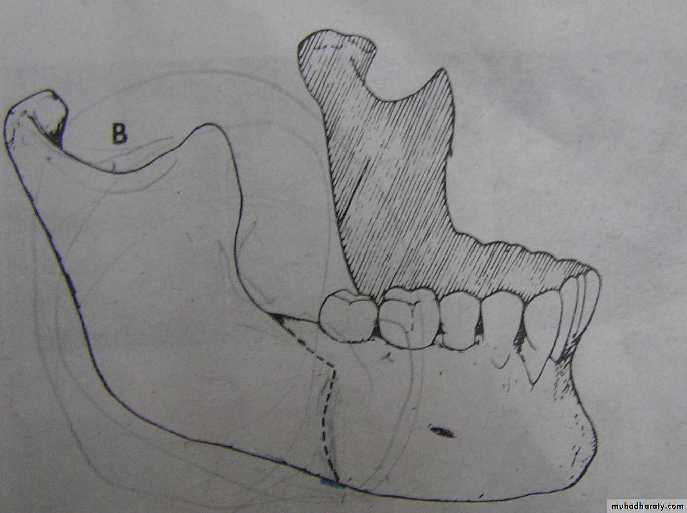 orthognathic surgery