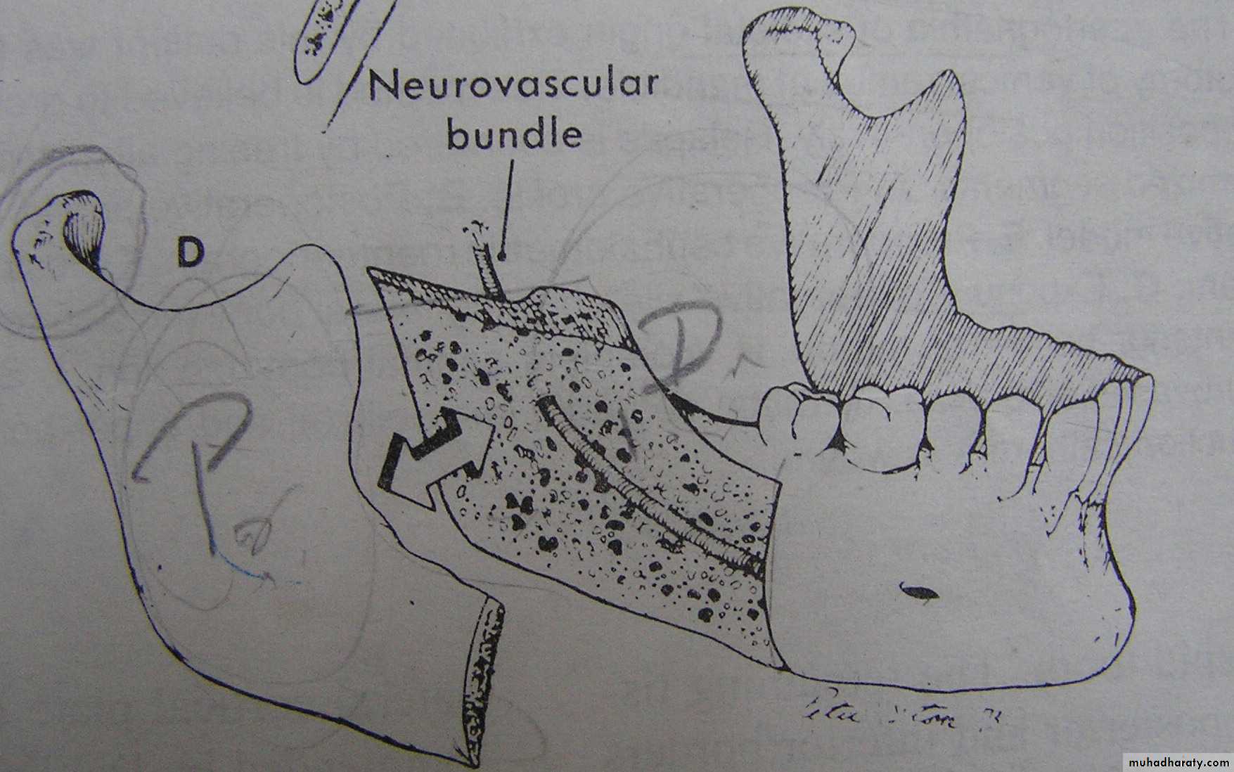 orthognathic surgery