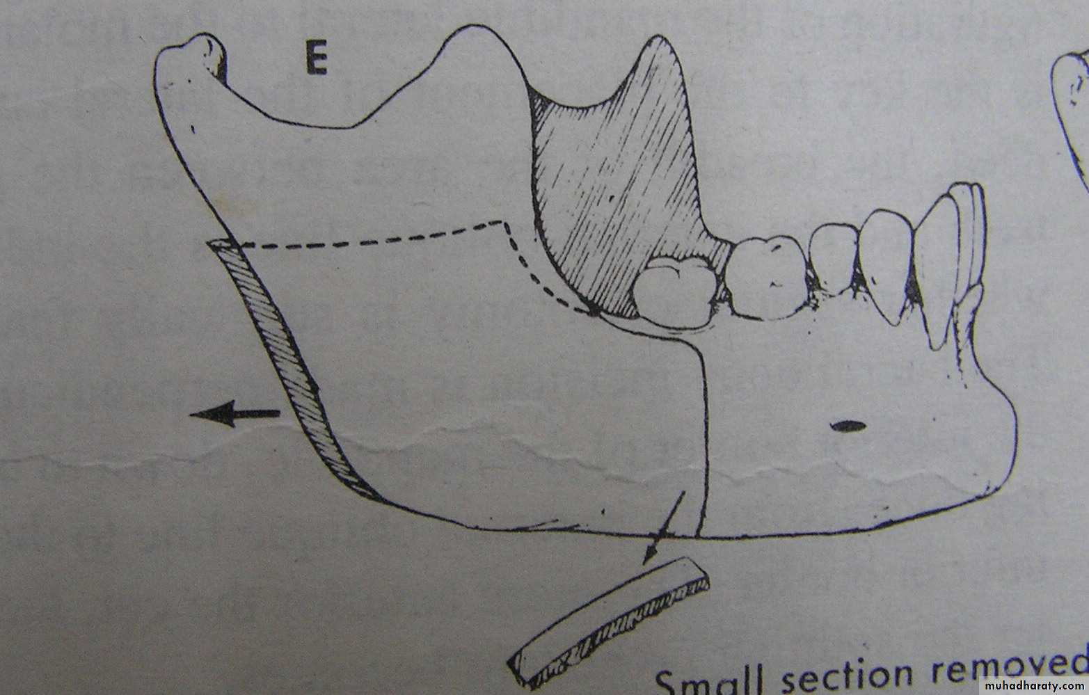 orthognathic surgery