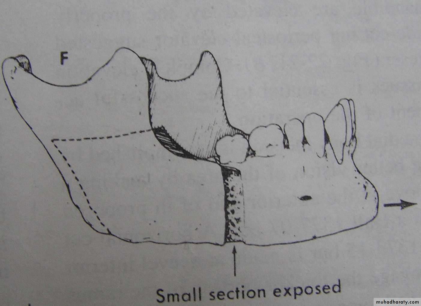 orthognathic surgery