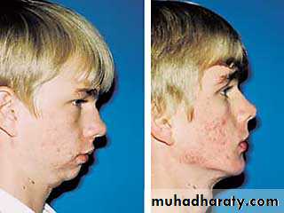 orthognathic surgery