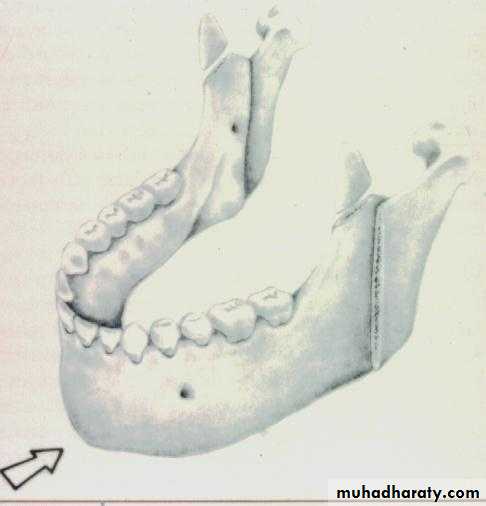 orthognathic surgery