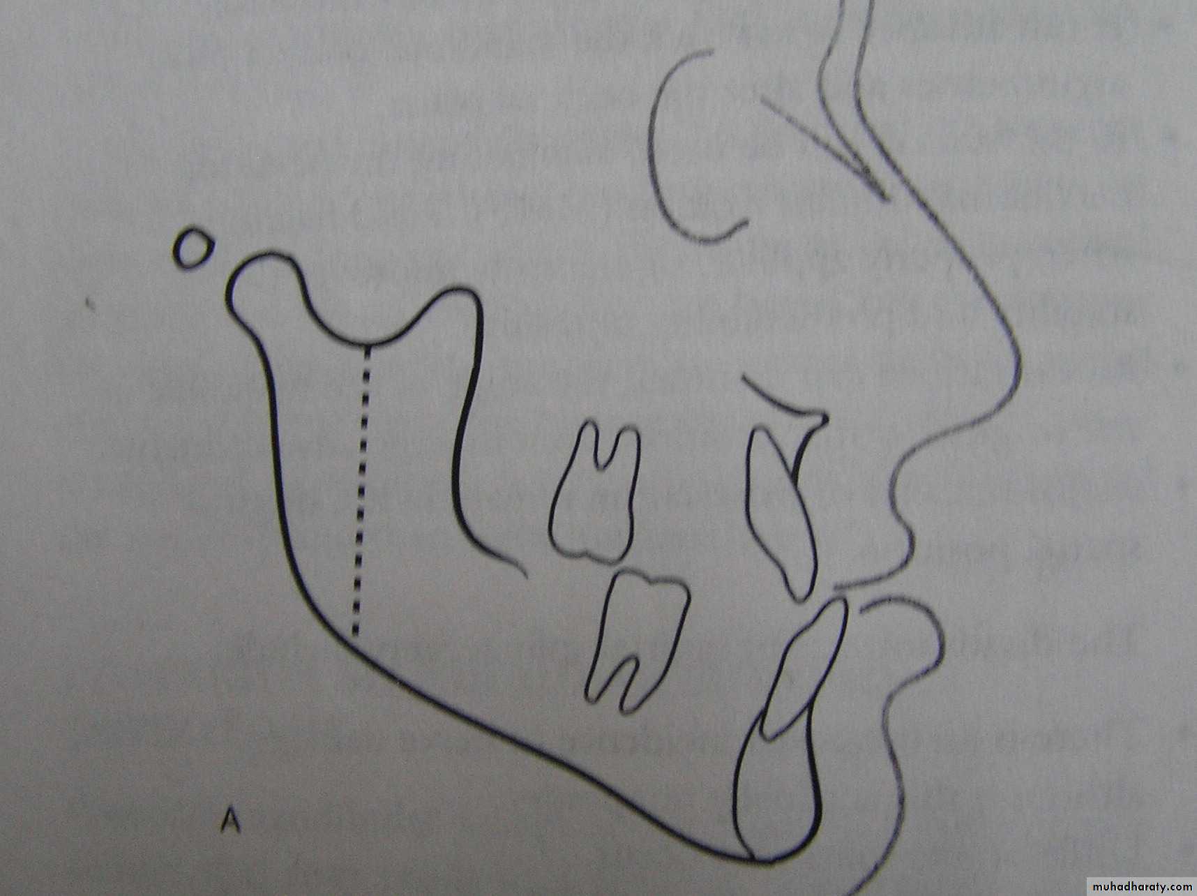 orthognathic surgery