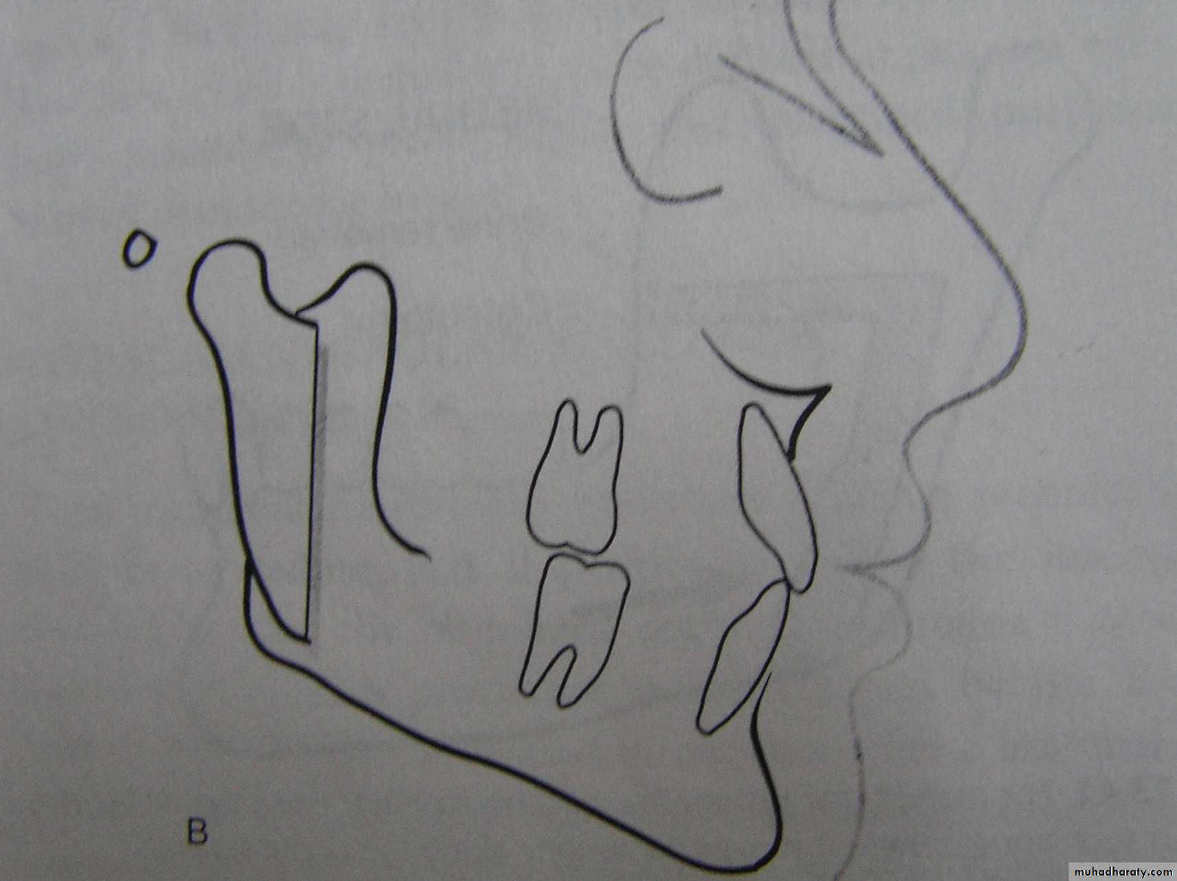 orthognathic surgery