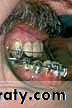 orthognathic surgery