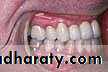 orthognathic surgery