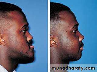 orthognathic surgery