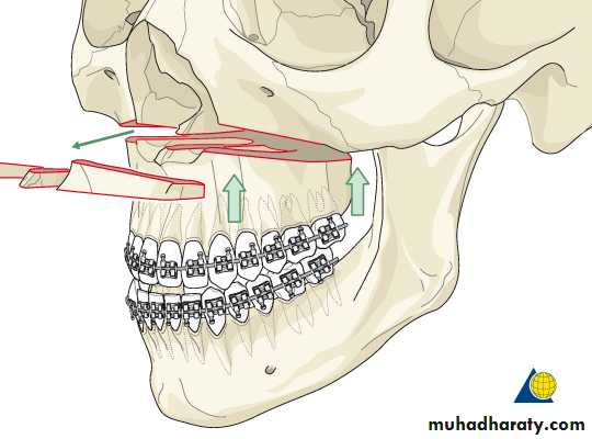 orthognathic surgery