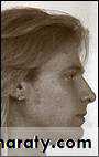 orthognathic surgery