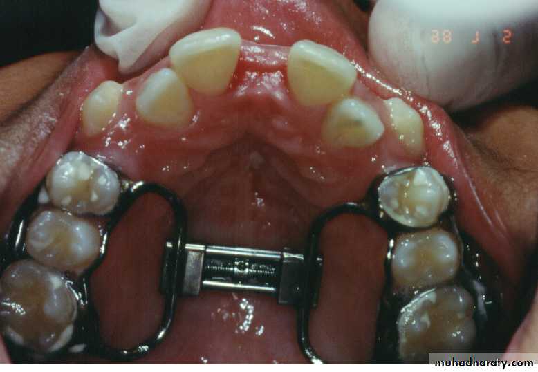 orthognathic surgery