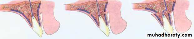 orthognathic surgery