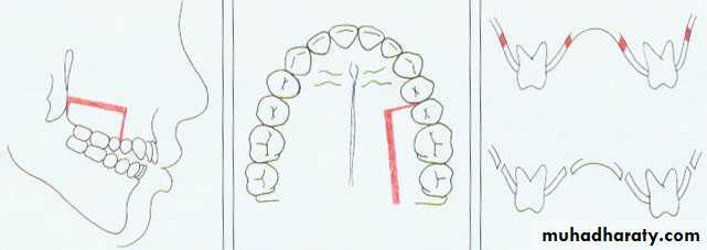 orthognathic surgery