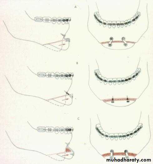 orthognathic surgery