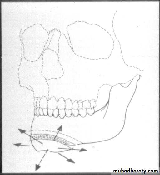 orthognathic surgery