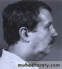 orthognathic surgery