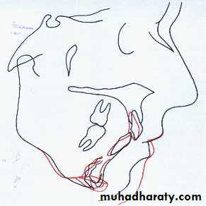 orthognathic surgery